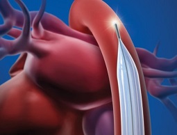 Minimally Invasive Hemodynamic Catheters